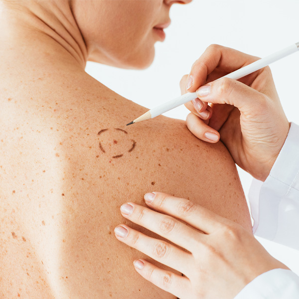 woman getting mole checked by doctor