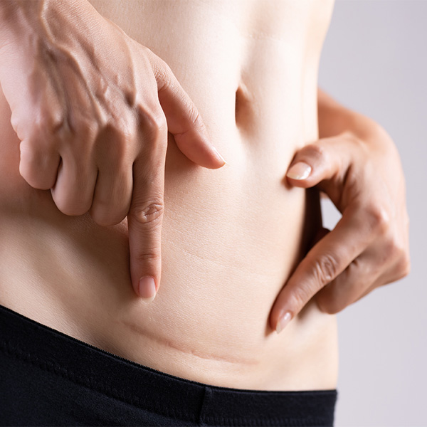 Closeup of woman showing on her belly dark scar from a cesarean section.