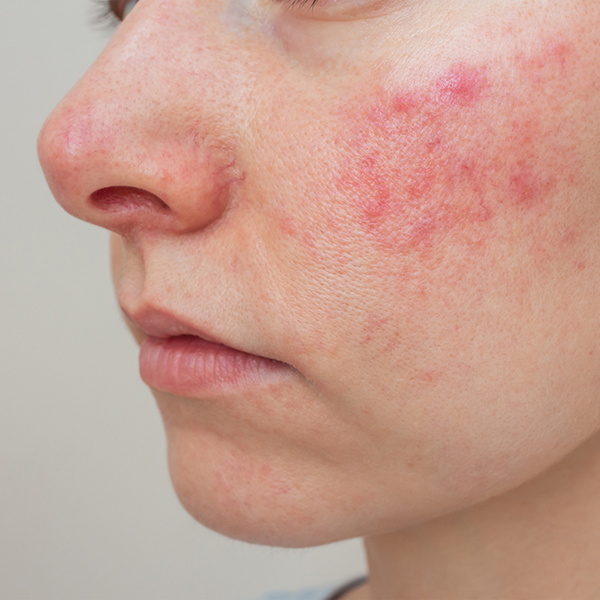 woman with rosacea